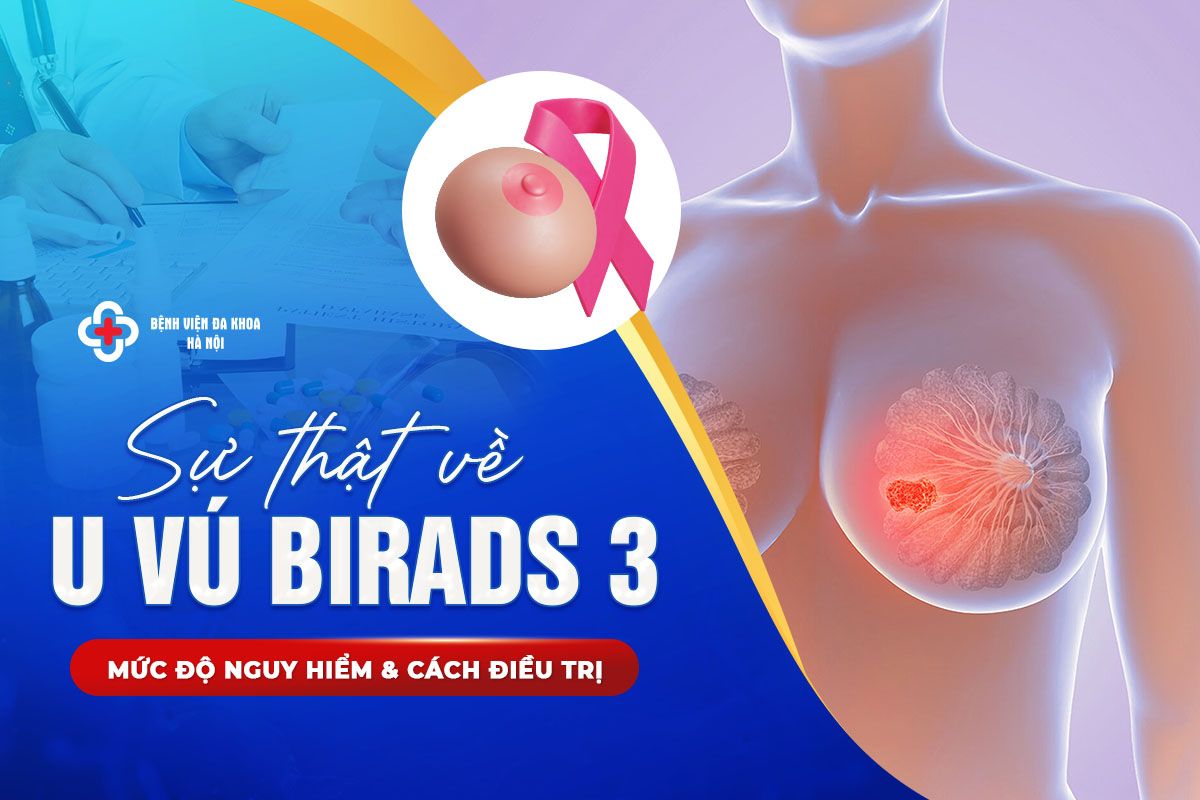 Sự Thật Về U Vú Birads 3: Mức Độ Nguy Hiểm & Cách Điều Trị
