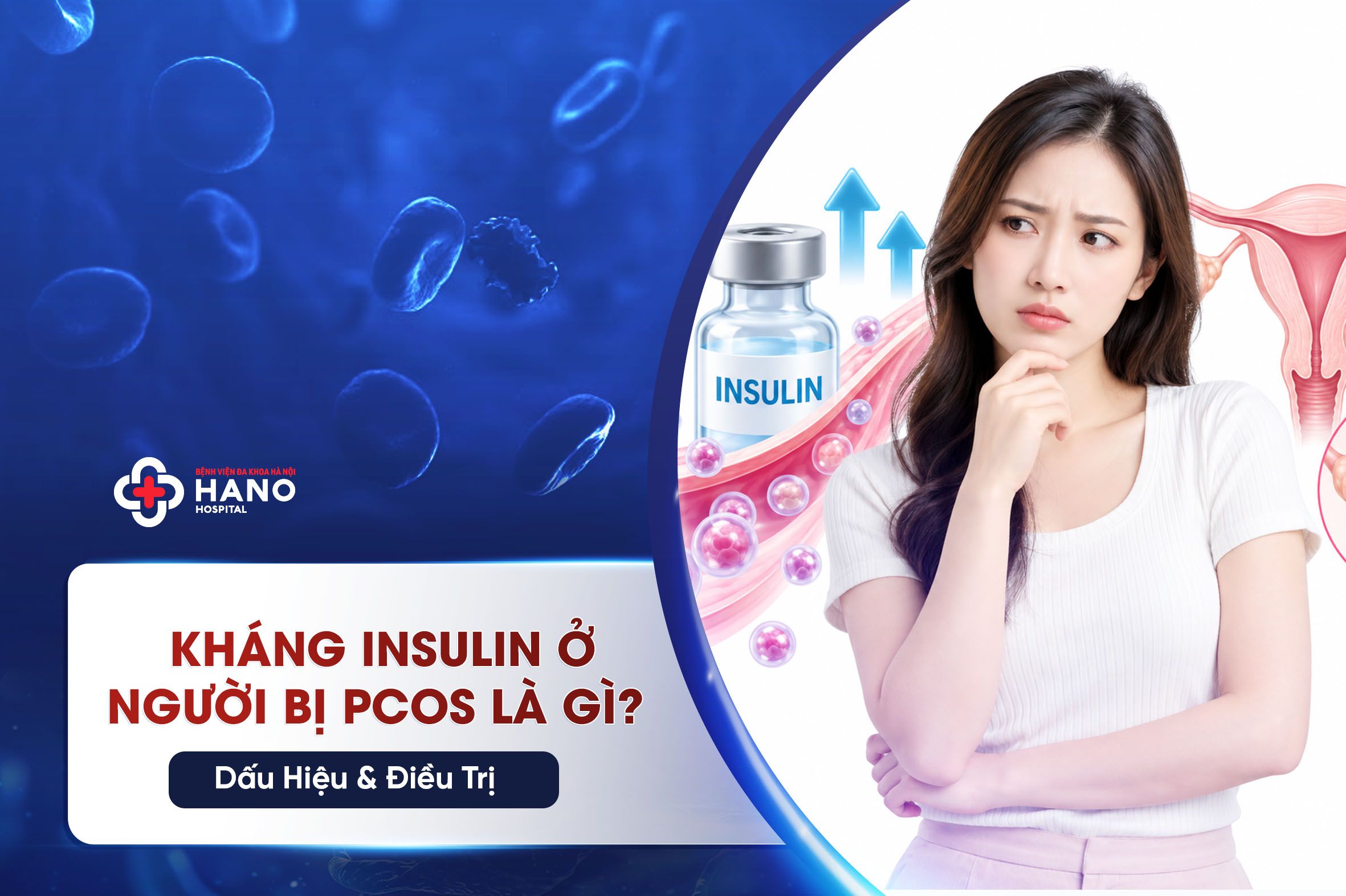 Kháng Insulin Ở Người Bị PCOS Là Gì? Dấu Hiệu & Điều Trị