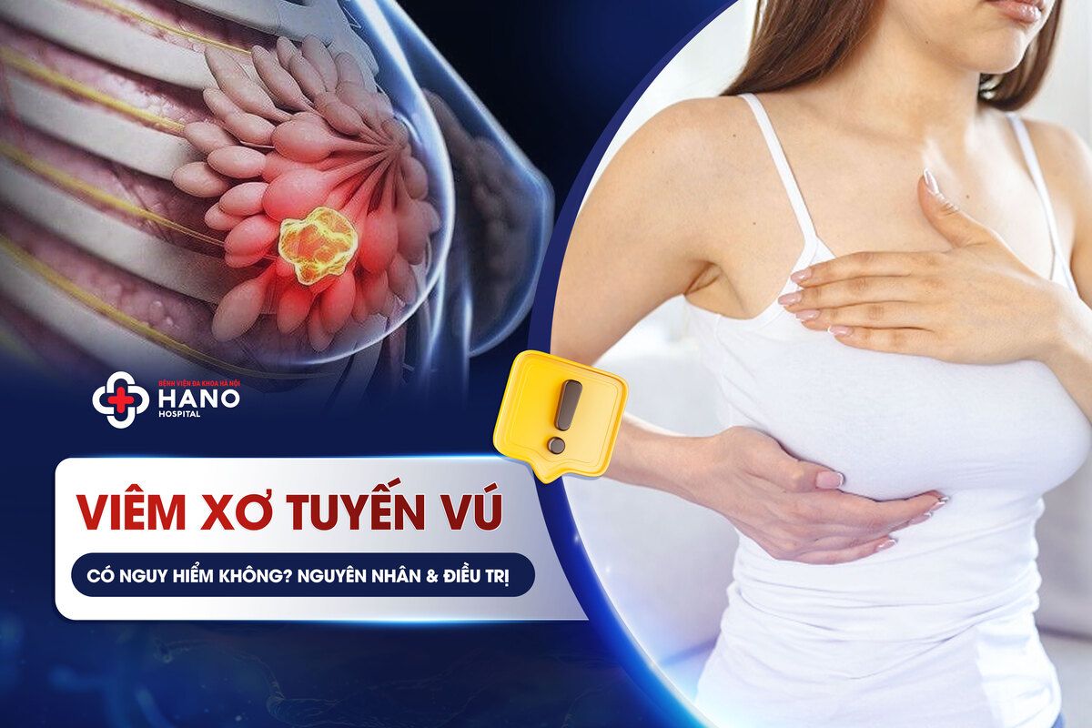 Viêm Xơ Tuyến Vú Có Nguy Hiểm Không? Nguyên Nhân & Điều Trị