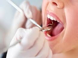 Lấy cao răng thường xuyên giúp phòng ngừa viêm lợi.