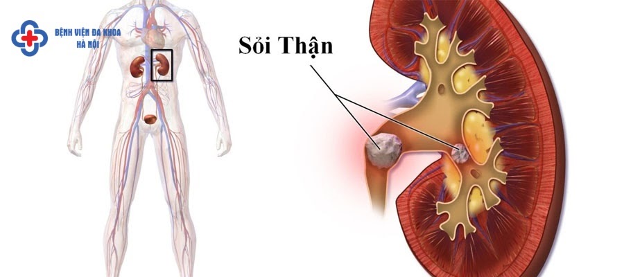 tán sỏi thận hết bao nhiêu tiền