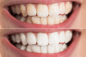 Mức độ trắng răng tùy thuộc cơ địa mỗi người.