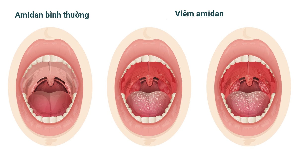 Các loại viêm họng thường gặp - Bệnh viện đa khoa Hà Nội