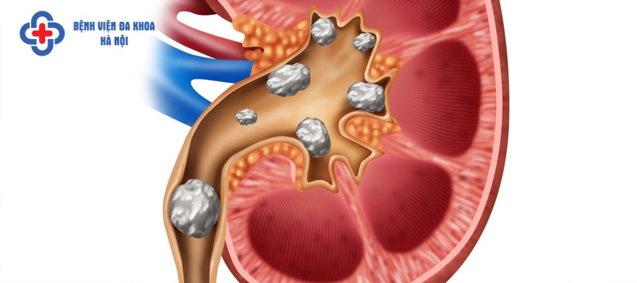 Sỏi thận là căn bệnh nhiều người mắc phải 