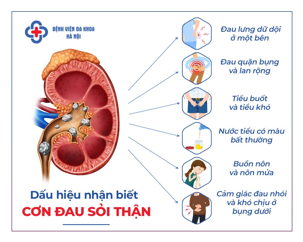 6 dấu hiệu nhận biết bạn bị đau sỏi thận