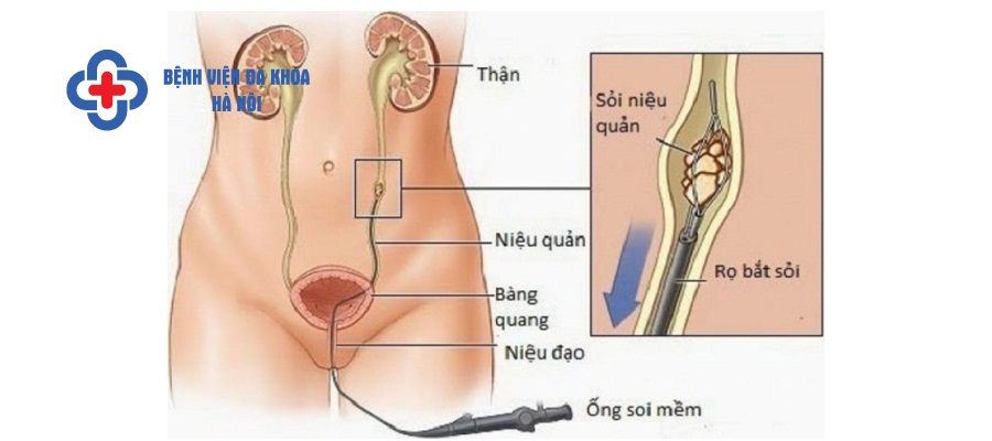 Tán sỏi nội soi ngược dòng có nhiều ưu điểm