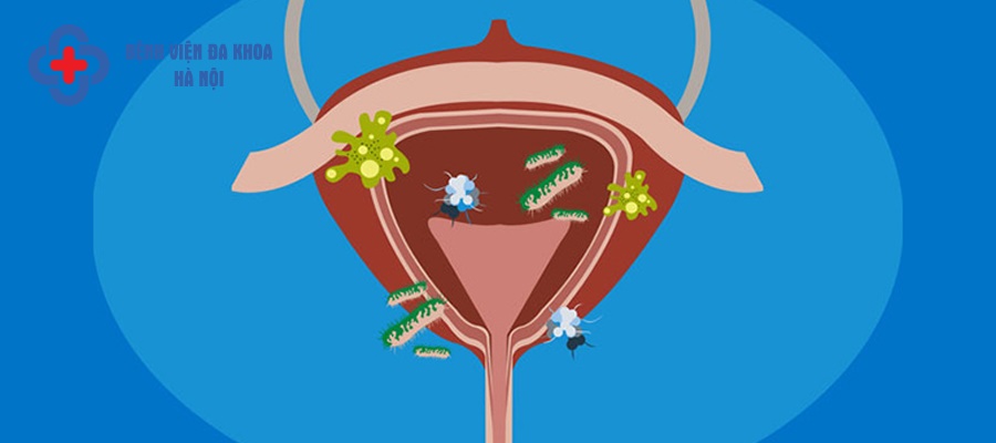 Nhiễm trùng thận, tiết niệu xảy ra khi vi khuẩn xâm nhập 