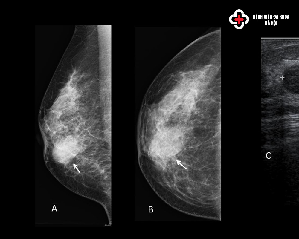 X-quang vú (mammography)