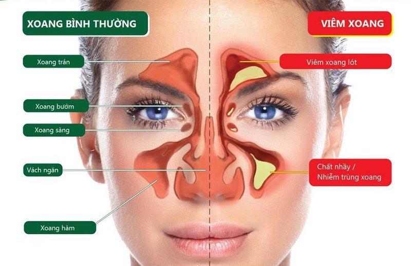 Ai nên được thực hiện nội soi xoang mũi?
