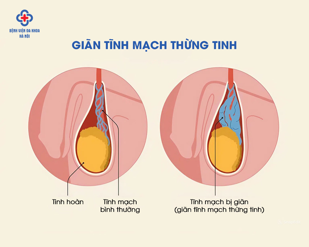 Giãn tĩnh mạch thừng tinh