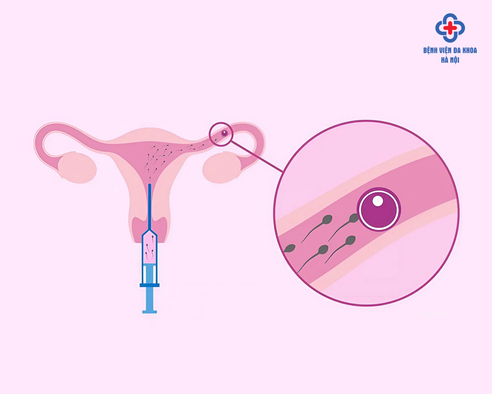 IUI phù hợp với ai?