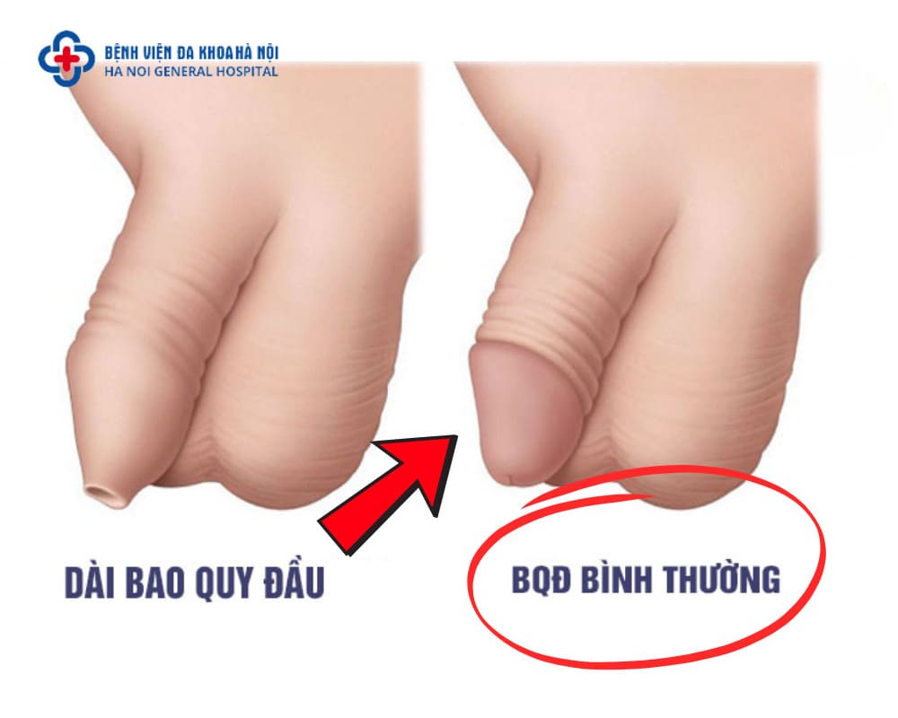 LỘT BAO QUY ĐẦU KHÔNG CẦN CẮT CHỈ VỚI THAO TÁC ĐƠN GIẢN