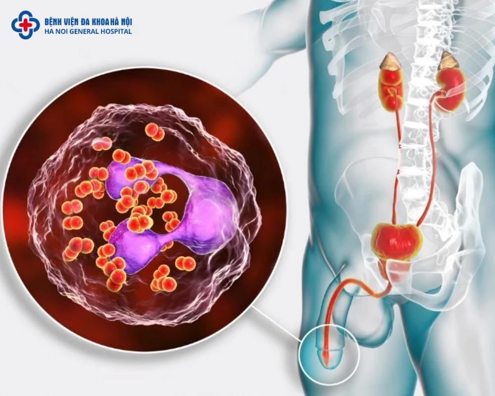 Bệnh lậu rất dễ lây lan rộng, chủ yếu qua đường tình dục
