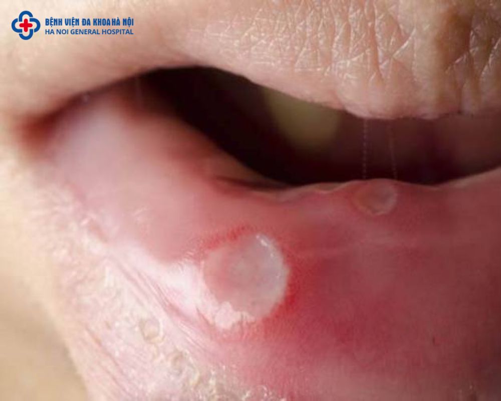 Hình ảnh bệnh lậu ở nam khi nhiễm trùng miệng