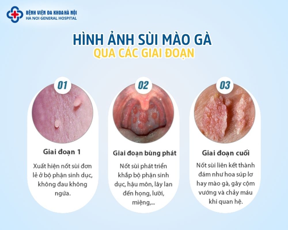 Hình ảnh sùi mào gà ở nữ qua các giai đoạn
