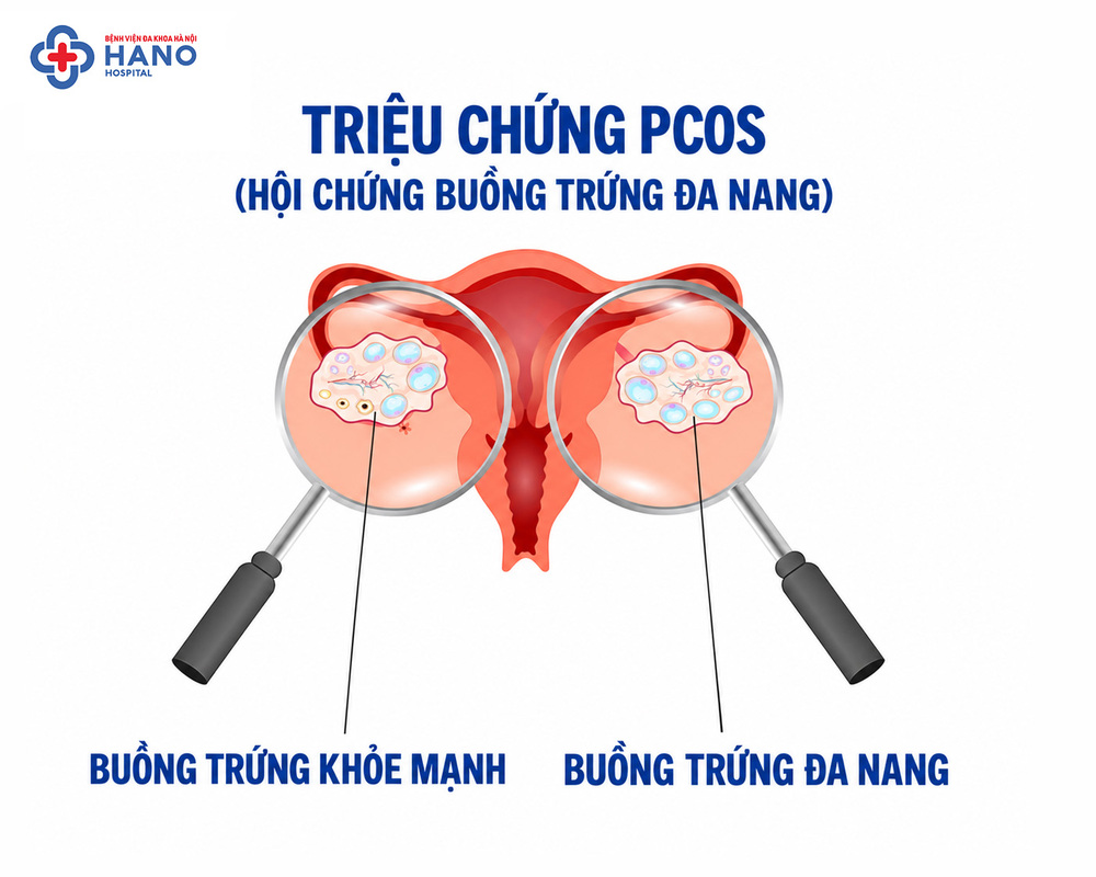 PCOS có kháng insulin nên làm gì để cải thiện?
