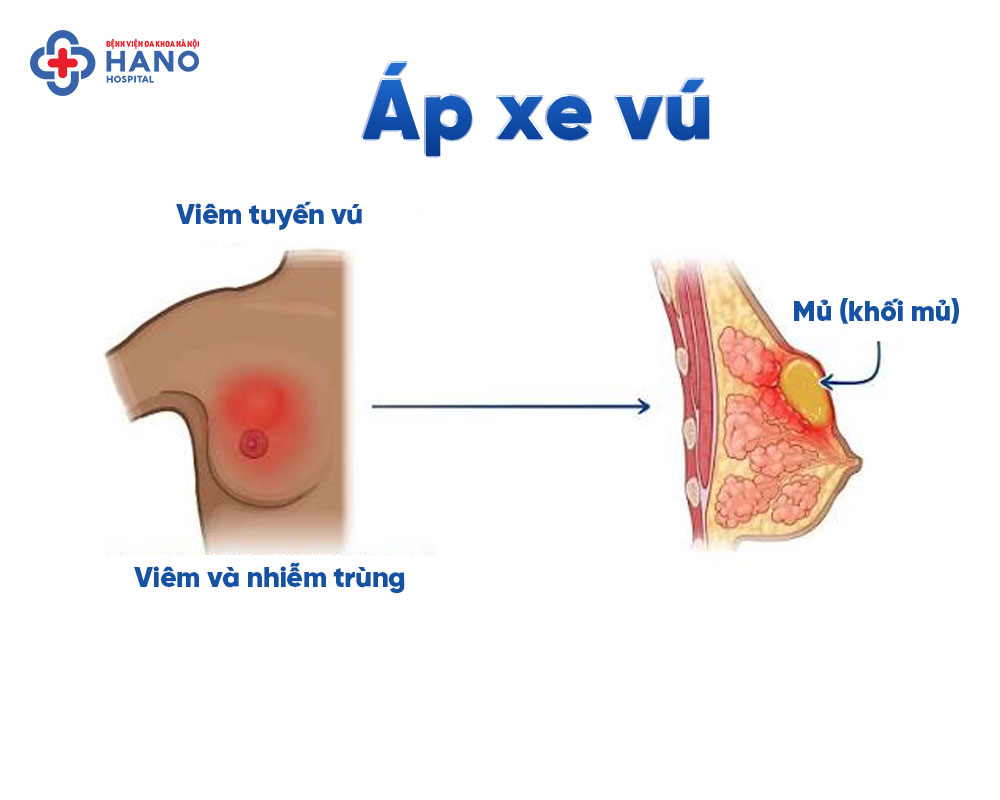Giải phẫu áp xe vú