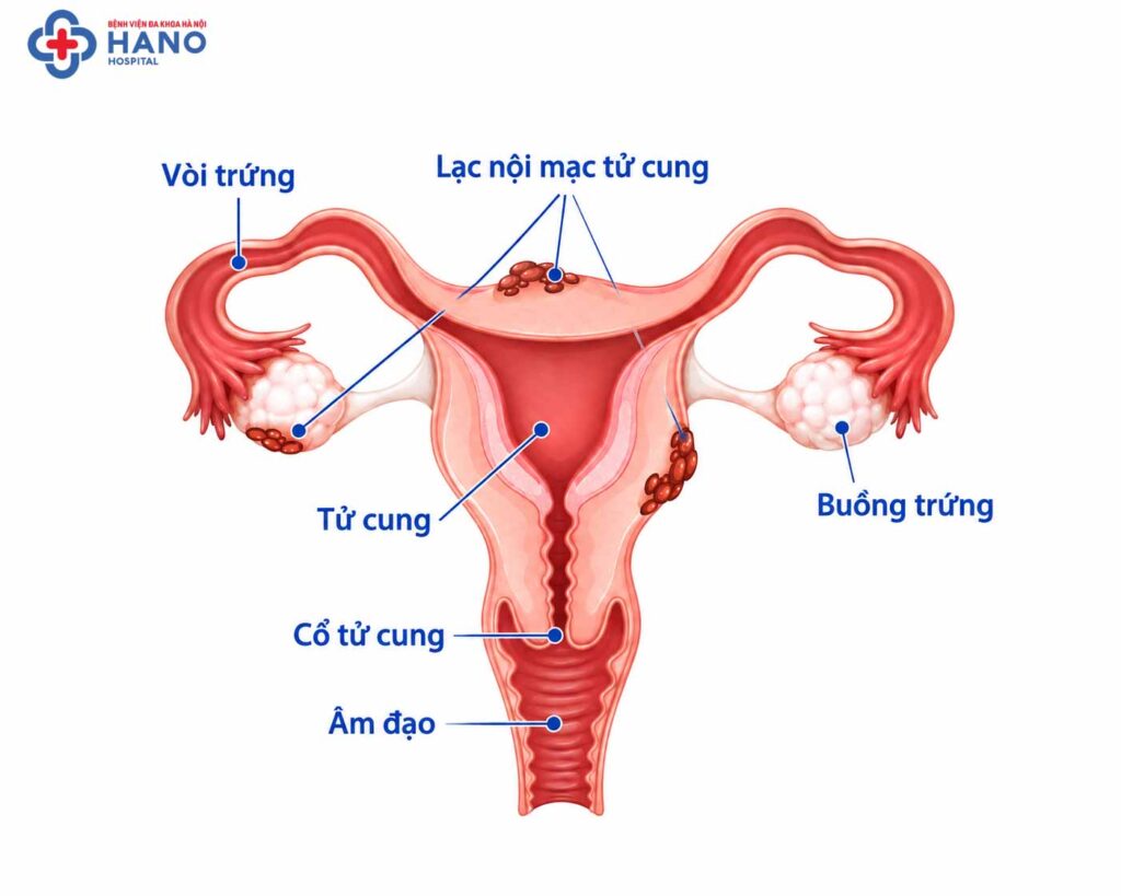 Giải phẫu tử cung lạc nội mạc tử cung
