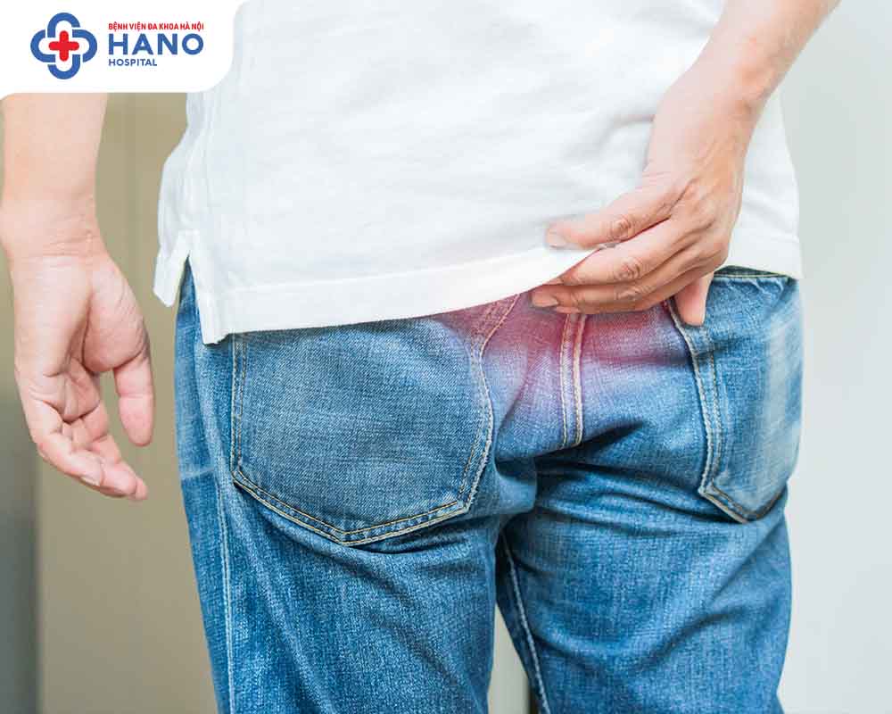 tối ưu chi phí khi cắt trĩ