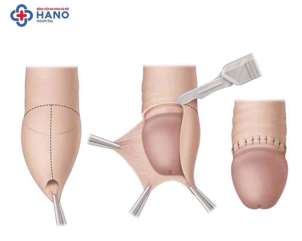 Giải phẫu cắt bao quy đầu