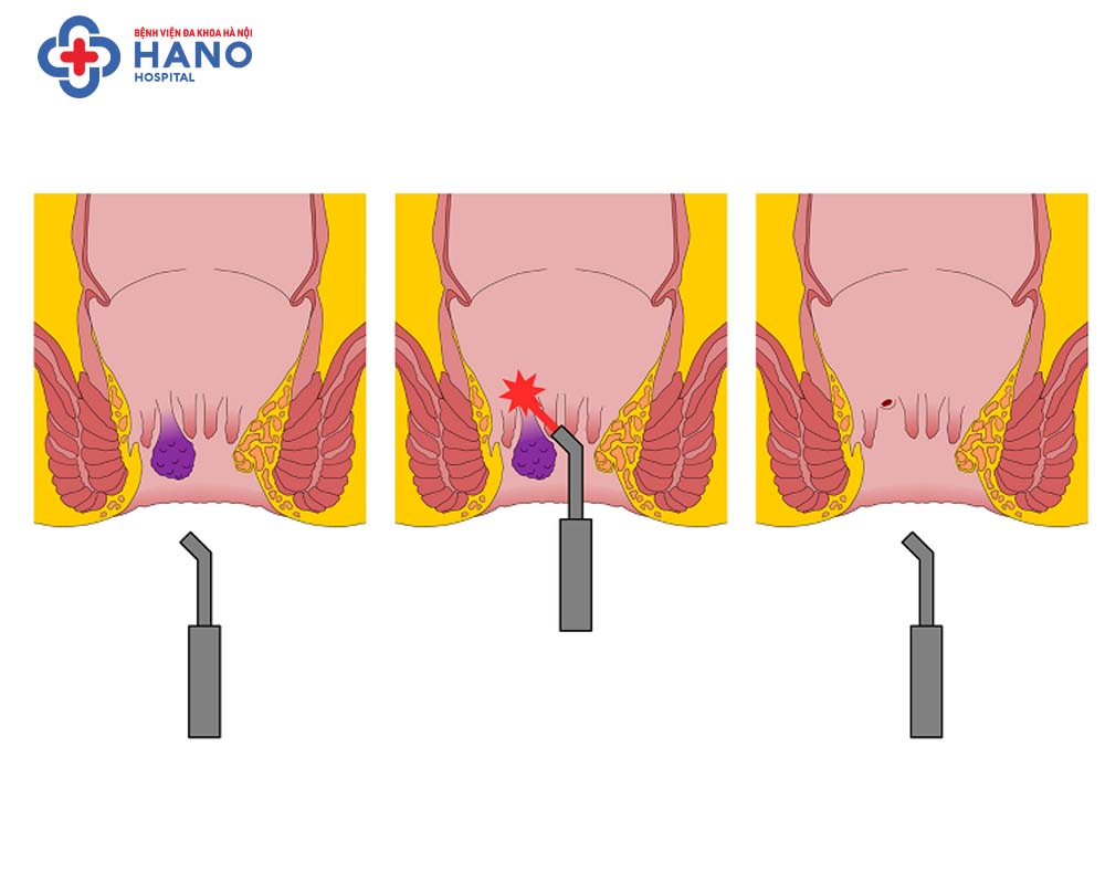 Quy trình cắt trĩ bằng laser