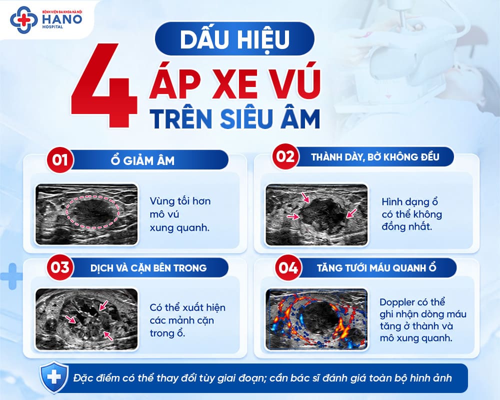 Bốn dấu hiệu áp xe vú trên siêu âm