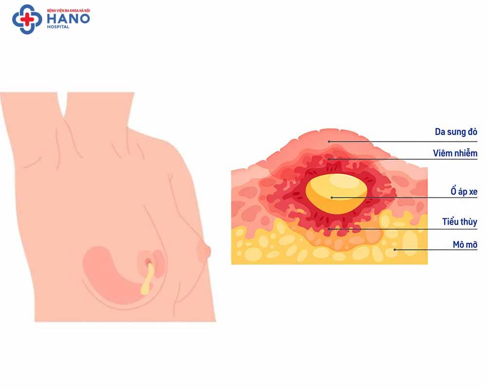 Giải phẫu khối áp xe vú