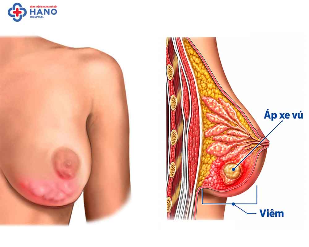 Khi ổ mủ hình thành, áp xe vú có biểu hiện gì?