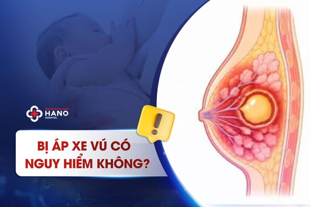 Bị Áp Xe Vú Có Nguy Hiểm Không? Khi Nào Cần Điều Trị?
